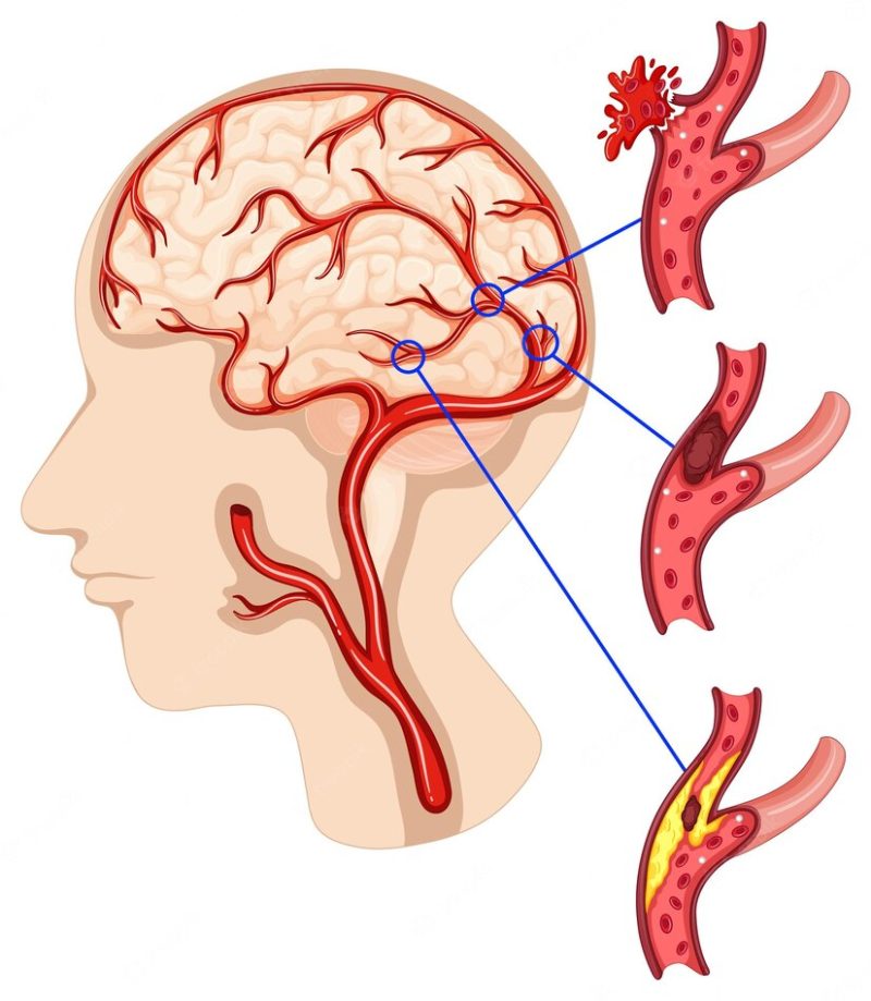 Caner in human brain Free Vector