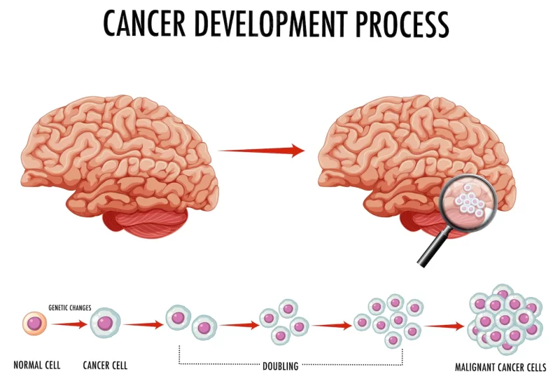 Diagram showing cancer in human brain Free Vector