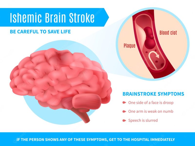 Ischemic brain stroke poster Free Vector